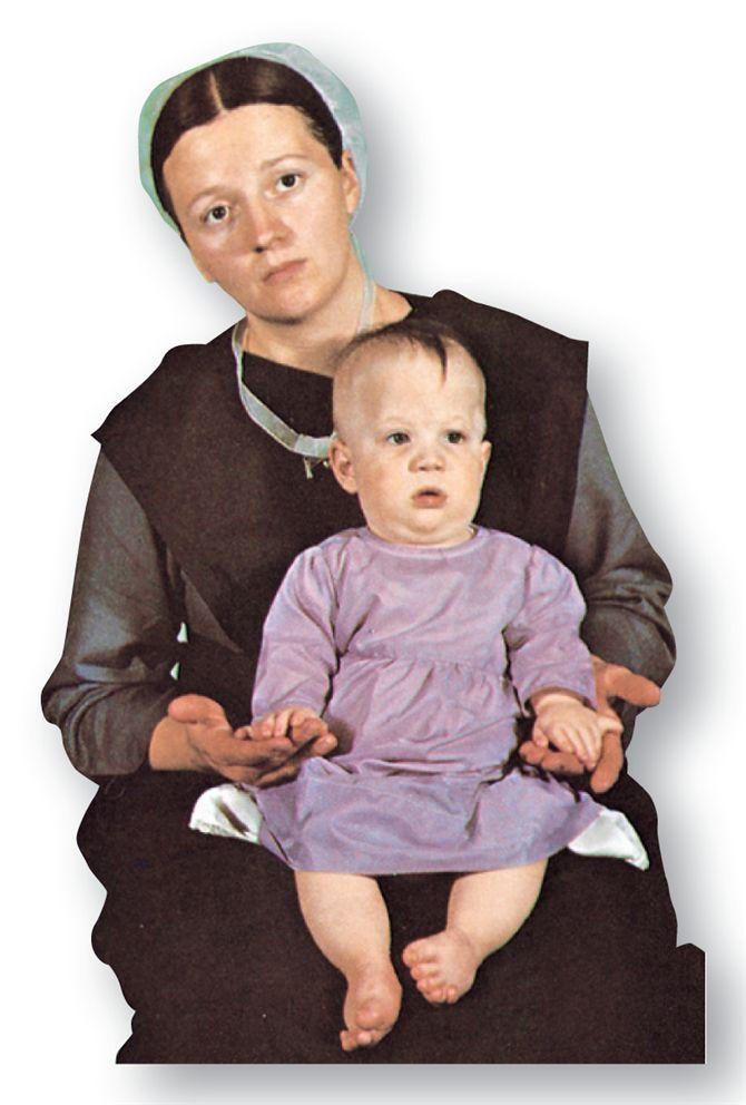 Sindrom Ellis-van Creveld